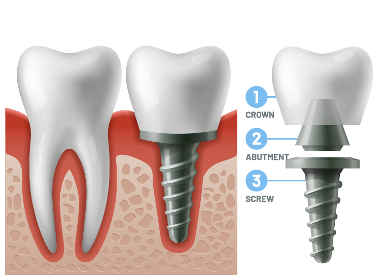 Dr. Hogan, Dental Implants, Columbia Periodontist, South Carolina, SC